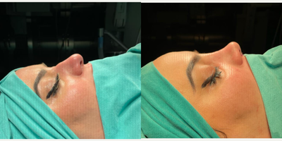 Rhinoplasty before and after photo