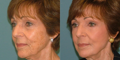 Laser Resurfacing before and after photo