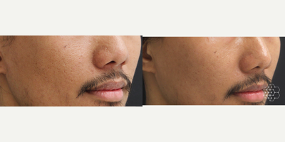Microneedling before and after photo