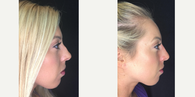 Nonsurgical Nose Job before and after photo