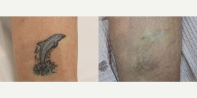 PicoWay before and after photo