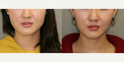 Botox before and after photo