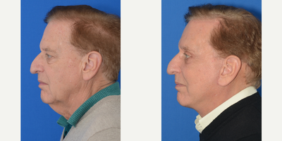 Facelift before and after photo