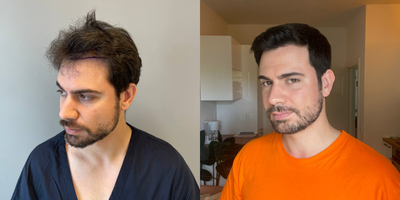 Hair Loss Treatment before and after photo