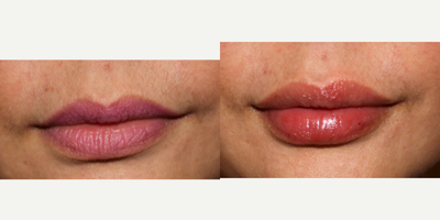 Lip Fillers before and after photo