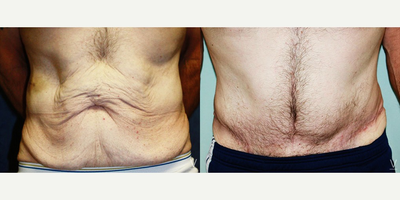 Male Tummy Tuck before and after photo