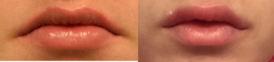 Lip Fillers before and after photo