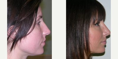 Rhinoplasty before and after photo