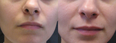Sculptra before and after photo