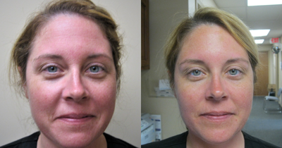 Botox before and after photo
