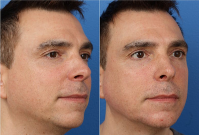 Botox before and after photo