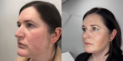Chin Liposuction before and after photo