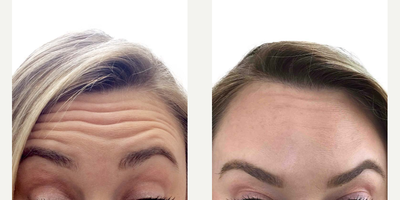 Dysport before and after photo