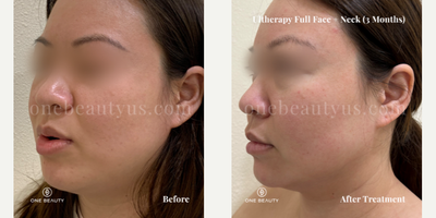 HydraFacial before and after photo