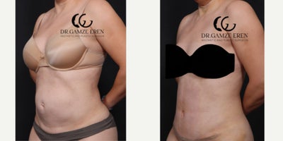 Liposuction before and after photo