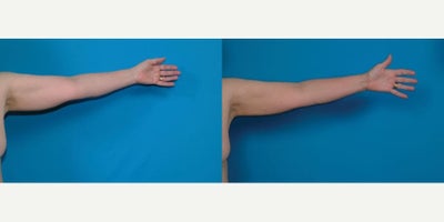 Liposuction before and after photo