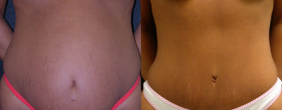 Tummy Tuck before and after photo