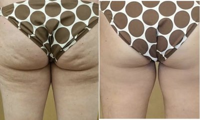 Velashape before and after photo