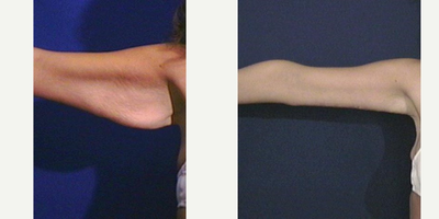 Arm Lift before and after photo