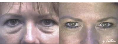 Eyelid Surgery before and after photo