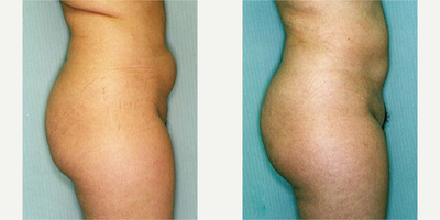 Liposuction before and after photo