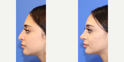 Rhinoplasty before and after photo