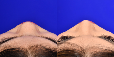 Asian Rhinoplasty before and after photo