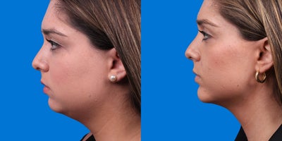Chin Implant before and after photo