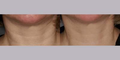 Dermal Fillers before and after photo