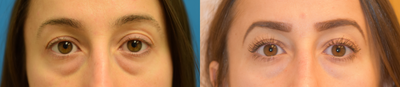 Eyelid Surgery before and after photo