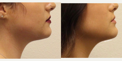 Kybella before and after photo