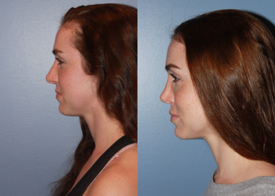 Rhinoplasty before and after photo