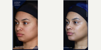 Rhinoplasty before and after photo