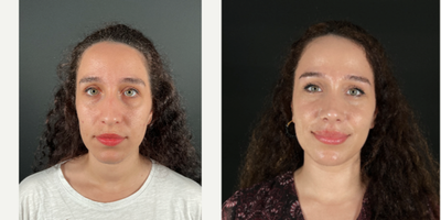 Rhinoplasty before and after photo