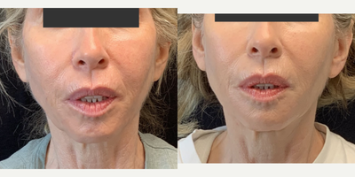 Volbella before and after photo