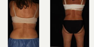 CoolSculpting before and after photo