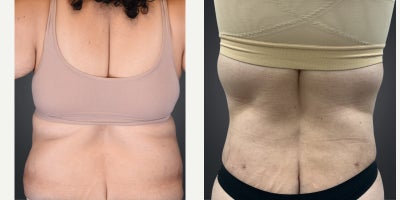 Diastasis Recti Repair before and after photo