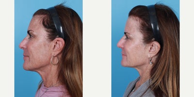 Eyelid Surgery before and after photo
