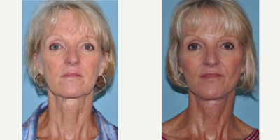 Facelift before and after photo