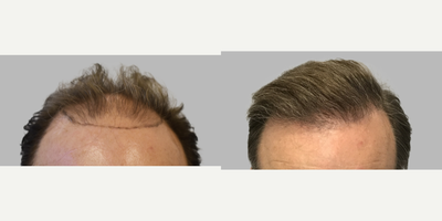FUE Hair Transplant before and after photo