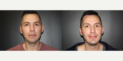 Liposuction before and after photo