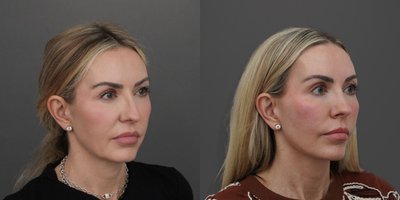 before and after image