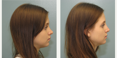 Nonsurgical Nose Job before and after photo