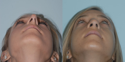 Rhinoplasty before and after photo