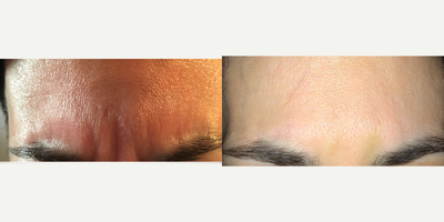 Botox before and after photo