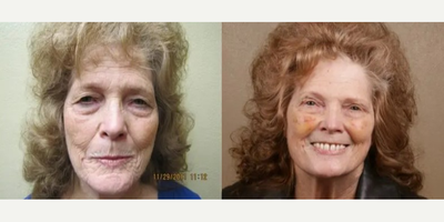 Eyelid Surgery before and after photo