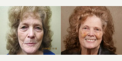Eyelid Surgery before and after photo