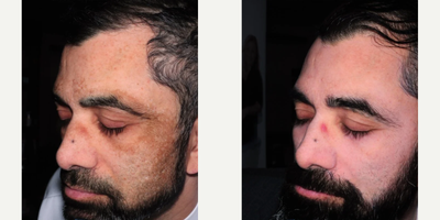 Laser Resurfacing before and after photo
