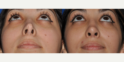 Revision Rhinoplasty before and after photo