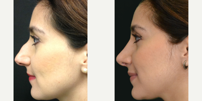 Rhinoplasty before and after photo